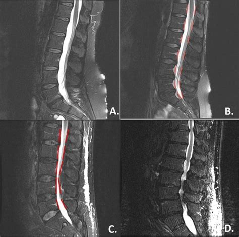 Mri Classification System For Lumbar Spinal Stenosis A Type I Normal