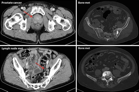 Ct Images Suggesting Primary Prostate Cancer Upper Left Panel Pelvic