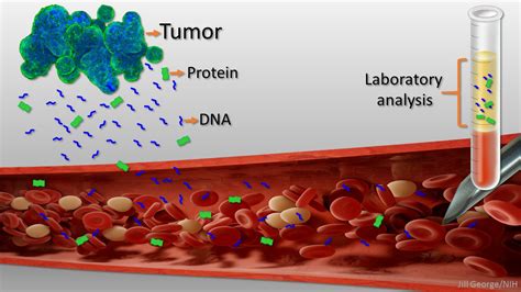 New Liquid Biopsy Shows Early Promise In Detecting Cancer NIH Director S Blog