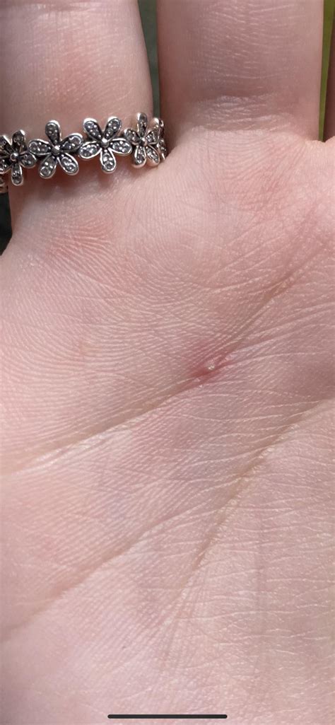 what are these small bumps on the palm of my hand i first noticed a couple of small clear bumps