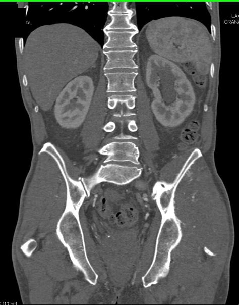 Bladder Cancer with Left Hydronephrosis - Kidney Case ...
