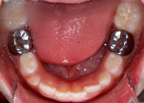 Hanya saja, sindrom teething tidak jarang diiringi dengan berbagai gejala serta kondisi yang kurang menyenangkan dan membuat bayi tidak nyaman. Gigi berlubang : Tampalan gigi untuk gigi susu ...