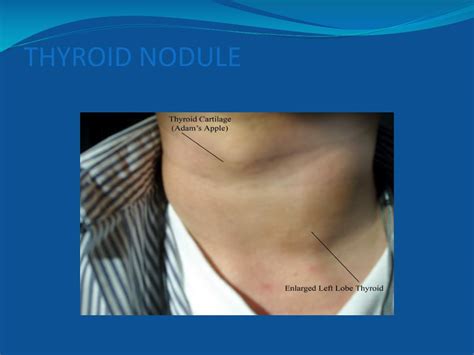 Ppt Physical Signs Of The Neck Powerpoint Presentation Free Download