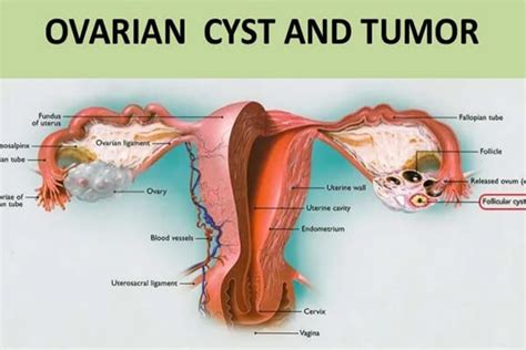 What Is The Difference Between Tumor And Cyst