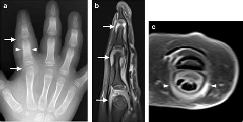 Psoriatic Dactylitis Initially Presenting As Prolonged Digital Swelling