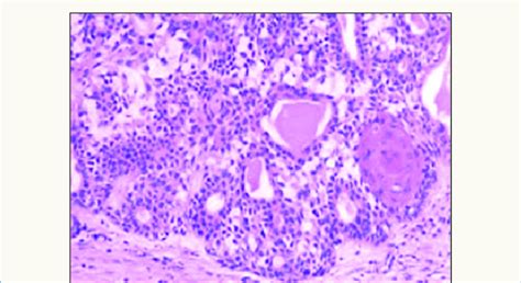 Cellular Myoepithelium In Pleomorphic Adenoma Minor Salivary Gland