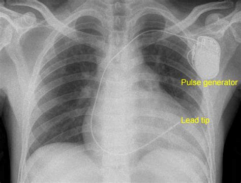 Cardiac Implantable Electronic Devices Cied On Cxr All About
