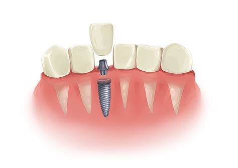 Dental Implant Options Ottawa: Endosteal Implant | Ottawa Dentist