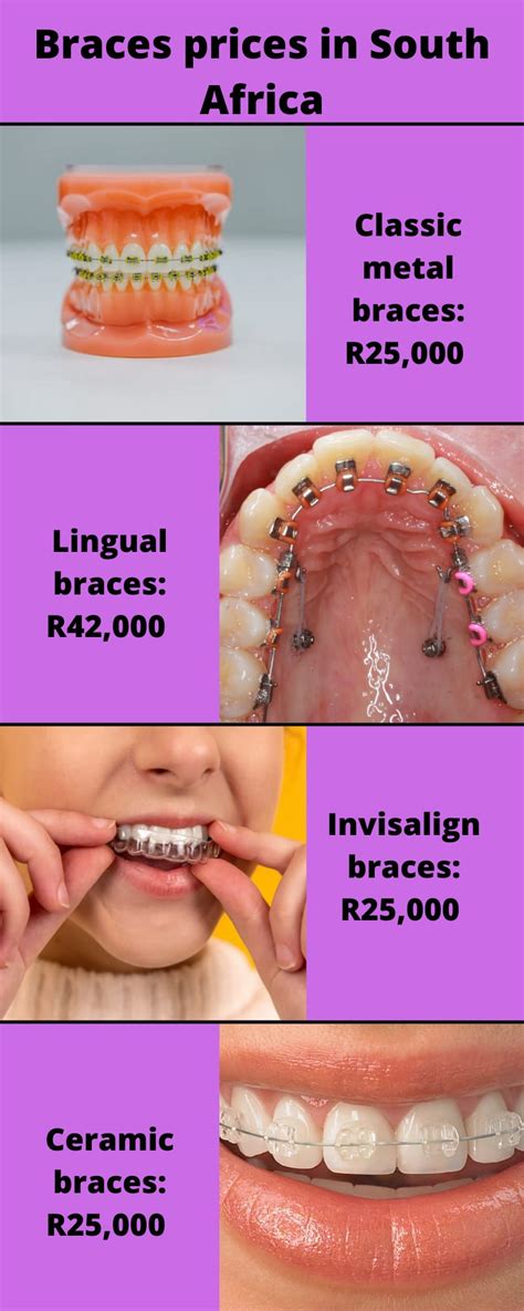 How Much Are Braces In South Africa 2023 Braces Price And Infographic Za