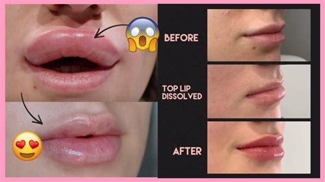 Week Lip Filler Swelling Stages
