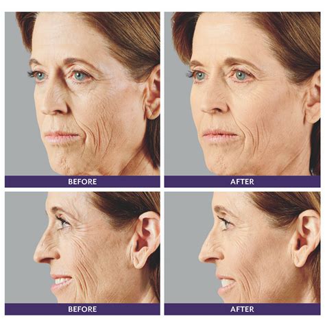 Facial Filler Before And After Feel Ideal Med Spa Southlake Tx