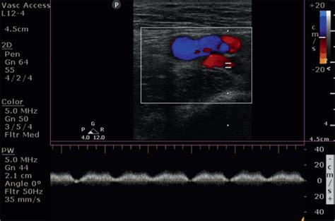 Vascular Ultrasound In The Critically Ill Radiology Key
