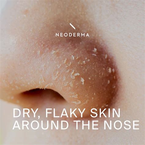 Dry Flaky Skin Around The Nose Neoderma