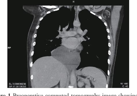 Figure 1 From Thoracic Duct Cyst Of Posterior Mediastinum A