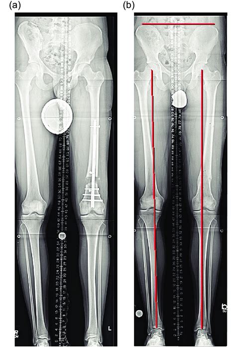 A The Lengthening Is Complete And The Limb Length Is Checked The