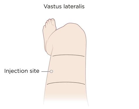 Intramuscular Injection Definition And Patient Education Patient