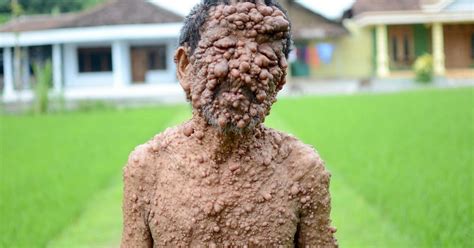 Neurofibromatosis Sufferer Slamet Pictured With Thousands Of Tumours