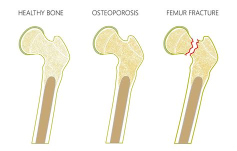 Osteoporosis Diagnosis And Treatment