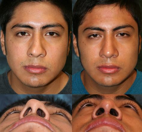 Nasal Fracture Facial Trauma