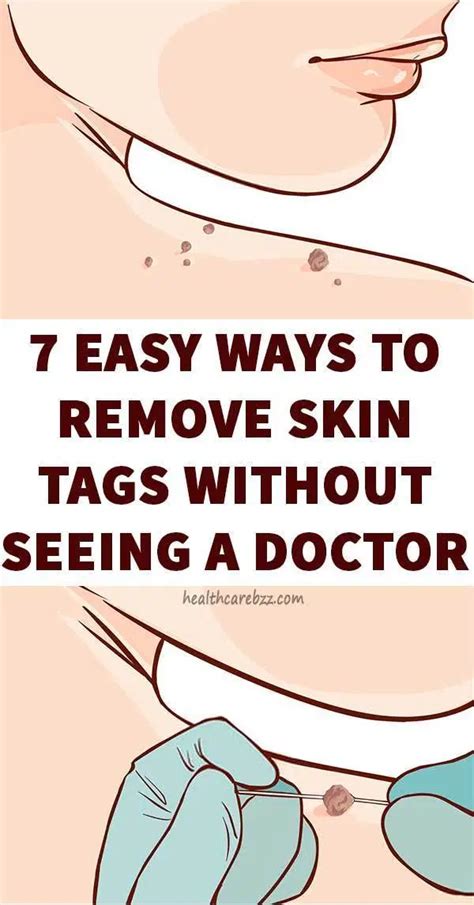 7 easy ways to remove skin tags without seeing a doctor healthcare in 2020 skin tag removal