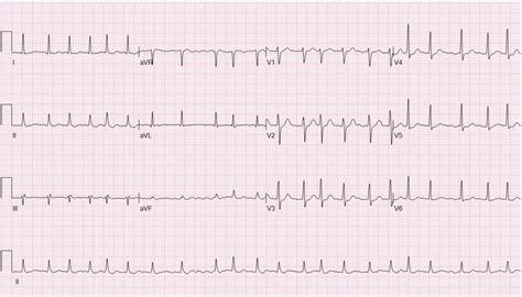 Fileecg Atrial Fibrillation Wikem