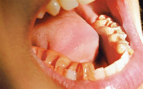 O Bite Bite Registration Dmg High Quality Dental Materials For