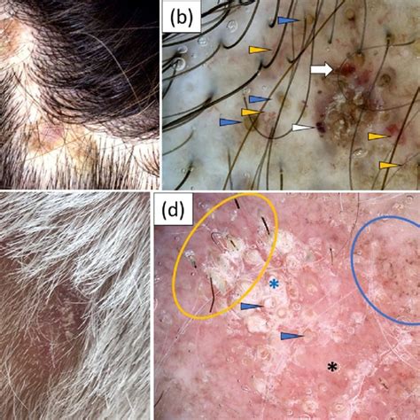 Clinical Presentation Of Discoid Lupus Erythematosus Dle Plaques On