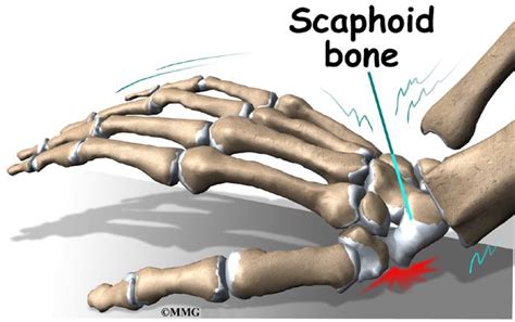 Scaphoid Fracture Of The Wrist Eorthopod Com Fractures Sprained Wrist Avascular Necrosis