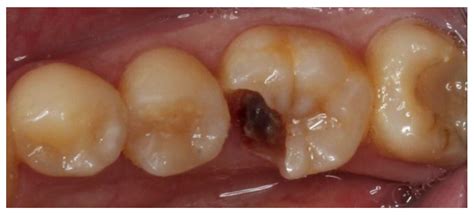 Dentistry Journal Free Full Text Restoring Large Defect Of Posterior Tooth By Indirect