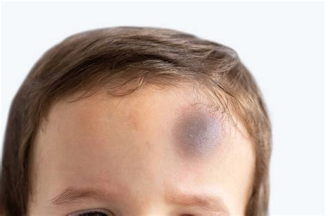 Cómo Curar Un Hematoma En La Cabeza Mibbmemima ️