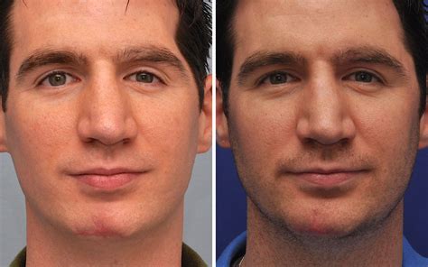 Scar Removal Before And After Photos Annapolis Md