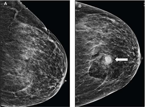 Bleeding After Image Guided Breast Biopsies Discontinuing Vs Maintaining Antithrombotic Therapy