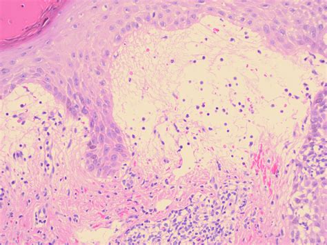 Polymorphous Light Eruption Histology