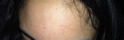 What Is This Patch Of Bumps On My Forehead Hypertrophic