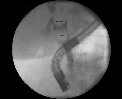 Ercp Shows Two Large Filling Defects In The Common Hepatic Duct