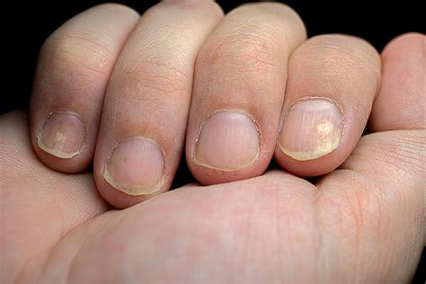 What Do Yellow Fingernails With Or Without Lifting Pitting Mean