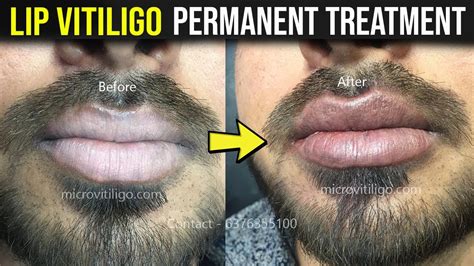 Lip Vitiligo Tattoo Lip Vitiligo Treatment Lip Viiligo Treatment By