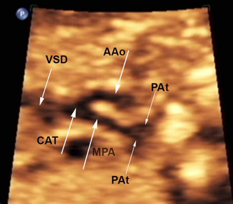 Fetal Trisomy 8 Mosaicism Associated With Truncus Arteriosus Type I Sherer 2017 Ultrasound