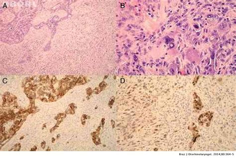 Carcinosarcoma De Novo Of The Parotid Gland With Unusual Sarcomatous