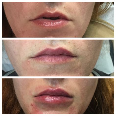 Beforeafter Botox Filler Kybella Laser Skin Care Augusta Ga