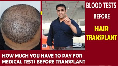 Blood Tests Before Hair Transplant In India How Much Medical Test