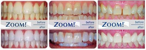 2022 End Of Year Smile Specials King Centre Dental Dentist Va 22315