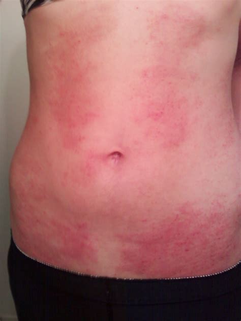 Rash On Stomach New Health Guide