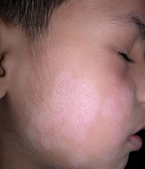 Manchas Blancas En La Cara En Niños Tratamiento Natural Vagabondtips