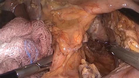 Esophagectomy is a common treatment for advanced esophageal cancer and is used occasionally for barrett's esophagus if aggressive precancerous cells are present. McKeown Esophagectomy - YouTube