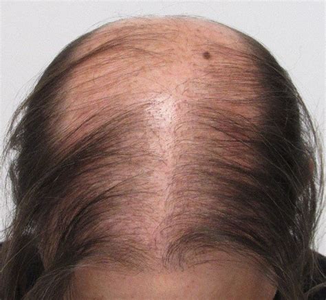 Hair Transplant Lies 5 Biggest Myths About Hair Restoration Hair