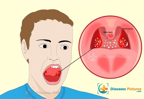 White Spots On Tonsils Should You Panic Swollen Tonsils Mouth Images