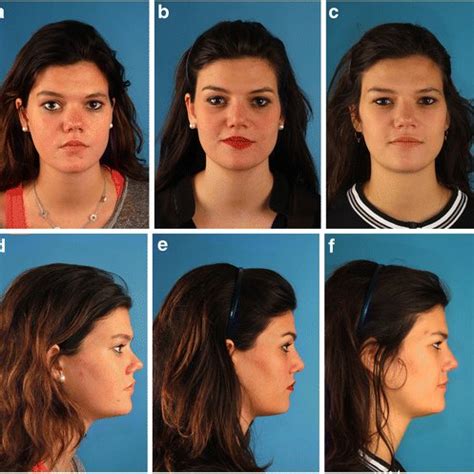 Preoperative And Postoperative Photographs A Preoperative Face Frontal