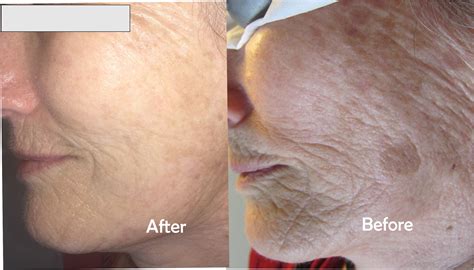 Age Spots On Face Removal