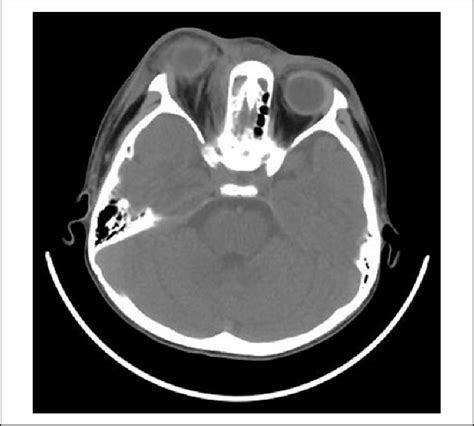 Preoperative Computed Tomography Ct Scan Illustrating A Mass Lesion
